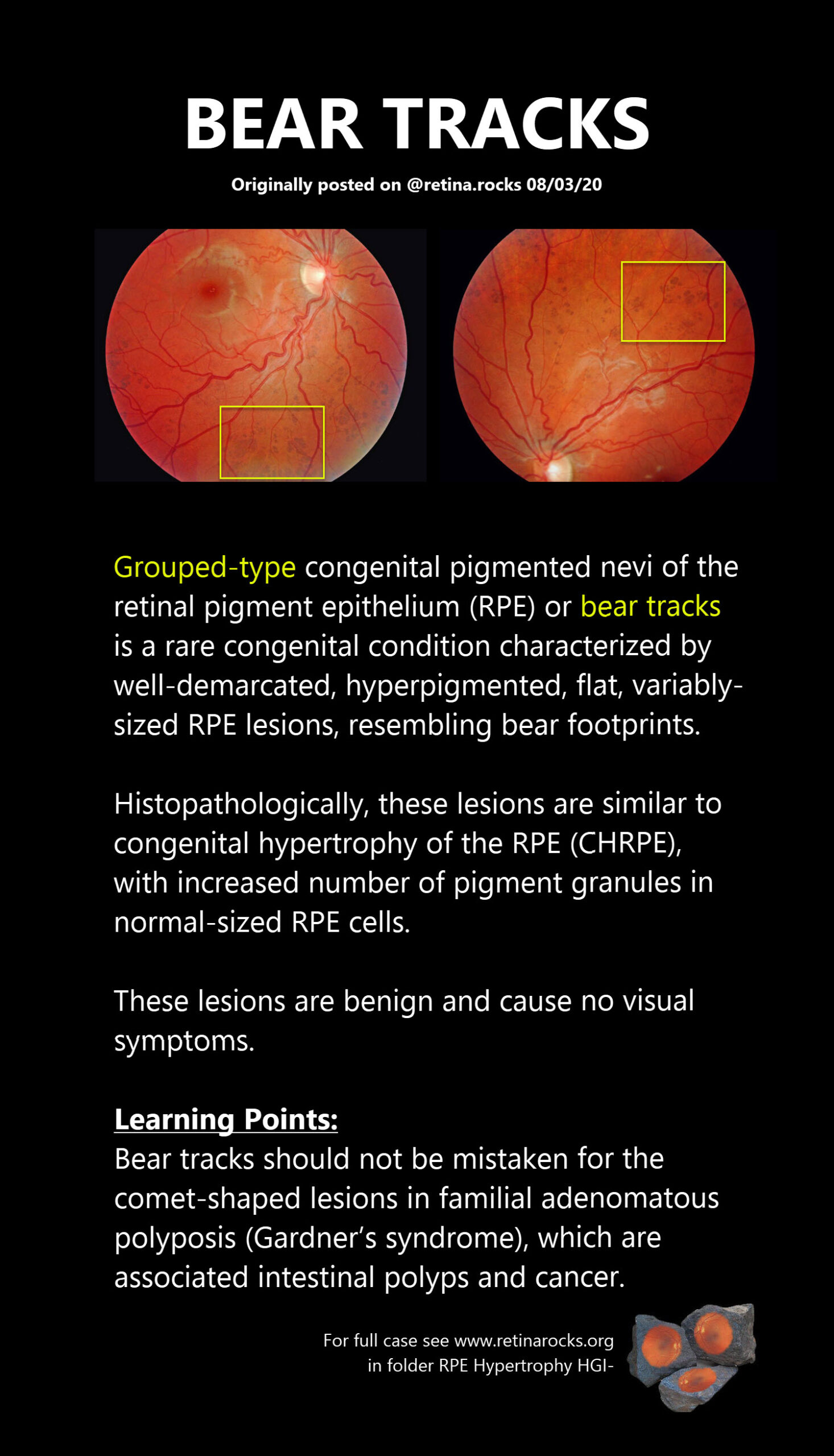 Tumors Of The RPE RPE Hypertrophy CHRPE Bear Tracks Retina Rocks