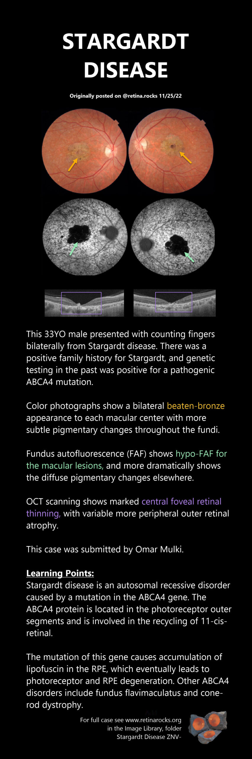 Inherited Retinal Diseases Stargardt Disease Fundus Flavimaculatus 