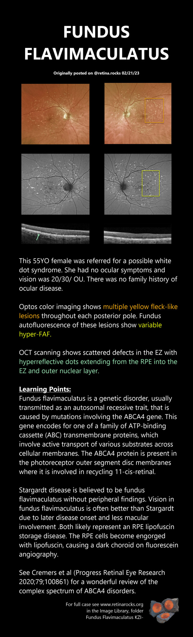 Inherited Retinal Diseases Stargardt Disease Fundus Flavimaculatus 