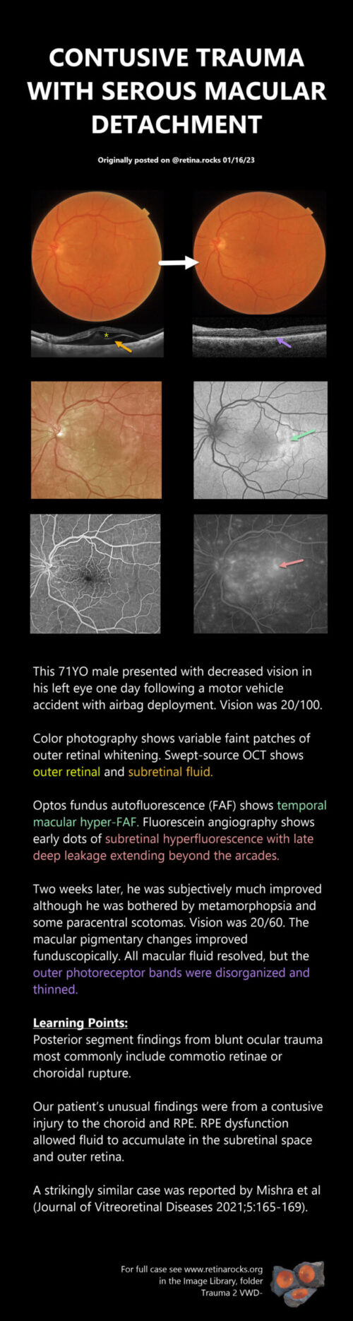 Pre Rpe Fluid Trauma > Contusive RPE Subretinal Fluid - Retina Rocks